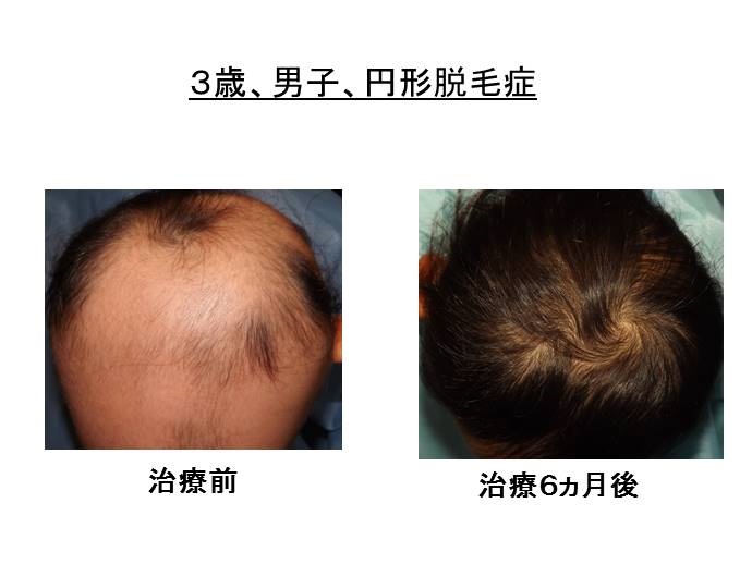円形脱毛症　病院""
